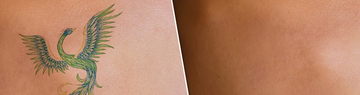 Обработка кожи перед и во время нанесения татуировки.
