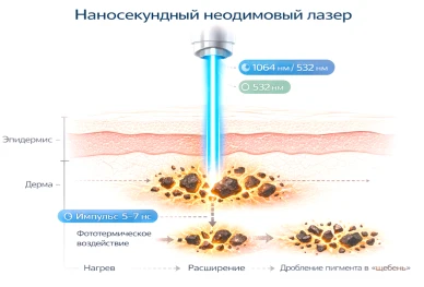 Принцип работы лазера Nd:YAG