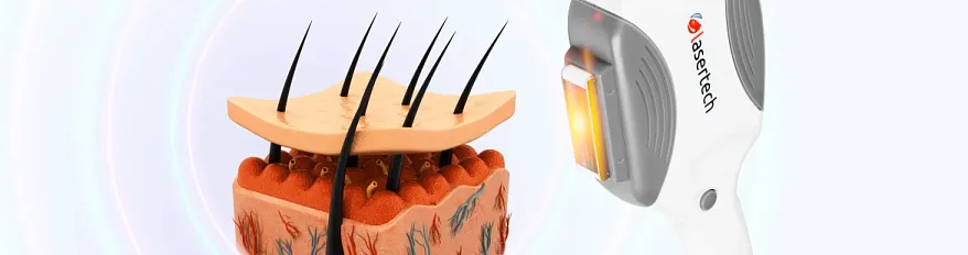 Какие результаты дает элос эпилятор после первой процедуры?